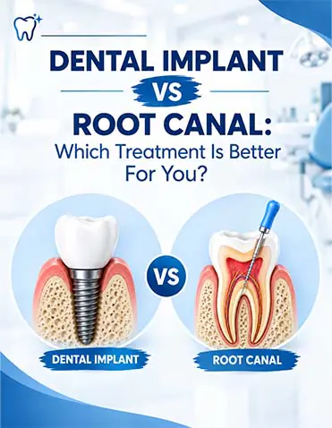 DENTAL IMPLANT VS ROOT CANAL: WHICH TREATMENT IS BETTER FOR YOU?